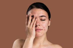 Ακμή: Γιατί παρουσιάζει έξαρση το καλοκαίρι;