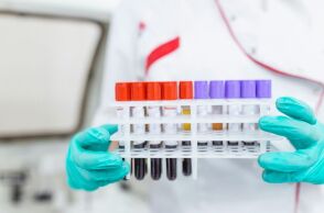 Βρετανοί επιστήμονες ανέπτυξαν την πρώτη ακριβή εξέταση αίματος για το σύνδρομο χρόνιας κόπωσης, προσφέροντας ελπίδα για έγκαιρη διάγνωση.