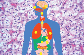 VHL σύνδρομο: Πώς είναι να ζεις με ένα σπάνιο νόσημα στην Ελλάδα του σήμερα