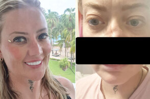 Γυναίκα γυρίζει σχεδόν χωρίς πρόσωπο μετά από οδοντική επέμβαση στην Τουρκία