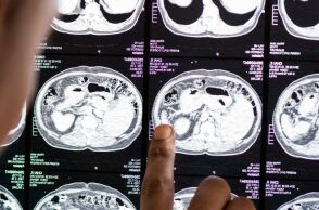 Καρκίνος: Εννιά εξετάσεις που πρέπει να κάνει κάθε ενήλικας για την πρόληψή του 