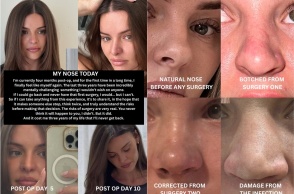 Οι εικόνες που δημοσίευσε influencer πριν και μετά την εγχείρησή της στη μύτη