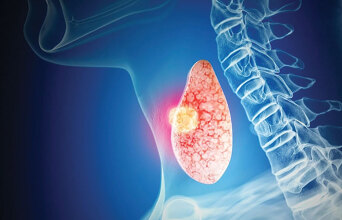 Καρκίνος θυρεοειδούς: Πώς αντιμετωπίζεται και πώς εξελίσσεται;