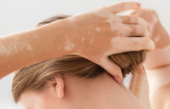 Λεύκη: Τι την προκαλεί και πώς μπορεί να βοηθήσει ο δερματολόγος