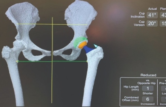 Νεότερες εξελίξεις στην αρθροπλαστική ισχίου