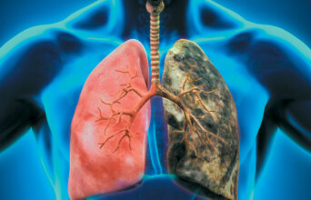 Καρκίνος του πνεύμονα
