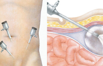 Εικονογράφηση λαπαροσκοπικής αντιμετώπισης της κήλης