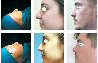 Αισθητική και λειτουργική αναβάθμιση της μύτης με τη νέα κλειστή ρινοπλαστική