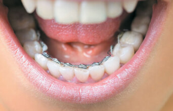 Νέες εξελίξεις στην ορθοδοντική ενηλίκων