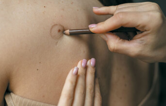 Χαρτογράφηση σπίλων: Προστατεύοντας το δέρμα μας