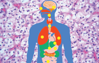 VHL σύνδρομο: Πώς είναι να ζεις με ένα σπάνιο νόσημα στην Ελλάδα του σήμερα