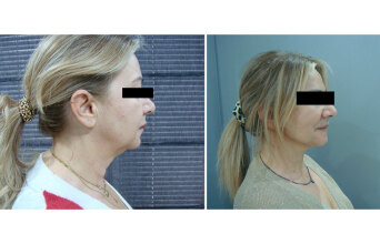 Deep Plane Face & Neck Lift