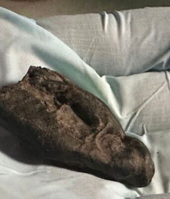 Αρχαίο DNA: Έφηβη μάσησε «τσίχλα» από φλοιό πριν από 10.500 χρόνια στην Εσθονία - Επιστήμονες ανέλυσαν ρητίνη σημύδας με αποτυπώματα δοντιών 