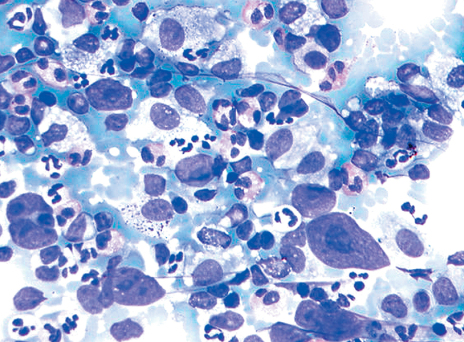 μη-Hodgkin λέμφωμα (ΜΗΛ)