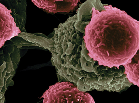 καρκίνος του πνεύμονα