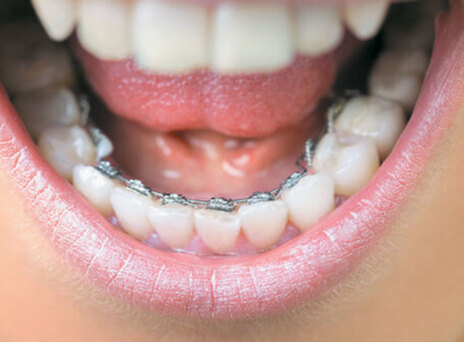 Νέες εξελίξεις στην ορθοδοντική ενηλίκων