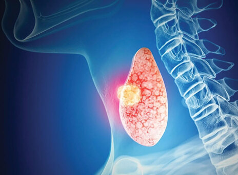 Καρκίνος θυρεοειδούς: Πώς αντιμετωπίζεται και πώς εξελίσσεται;
