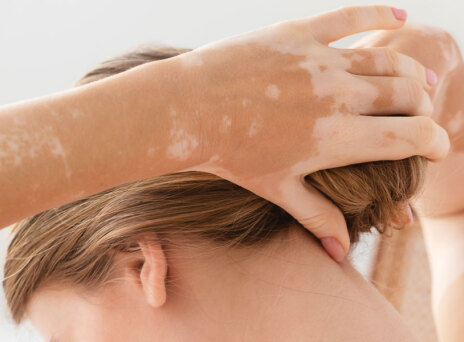 Λεύκη: Τι την προκαλεί και πώς μπορεί να βοηθήσει ο δερματολόγος