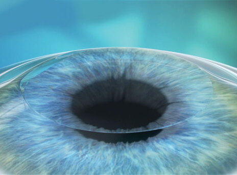 Διόρθωση Μυωπίας, Υπερμετρωπίας, Αστιγματισμού, Αντιμετώπιση πρεσβυωπίας