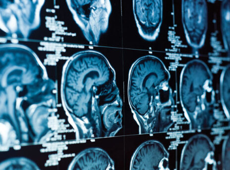 Πολλαπλή σκλήρυνση