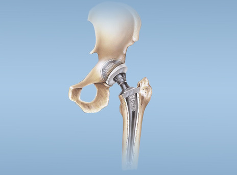 Αρθροπλαστική ισχίου και γόνατος