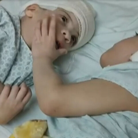 Τα σιαμαία που διαχωρίστηκαν στη Βραζιλία