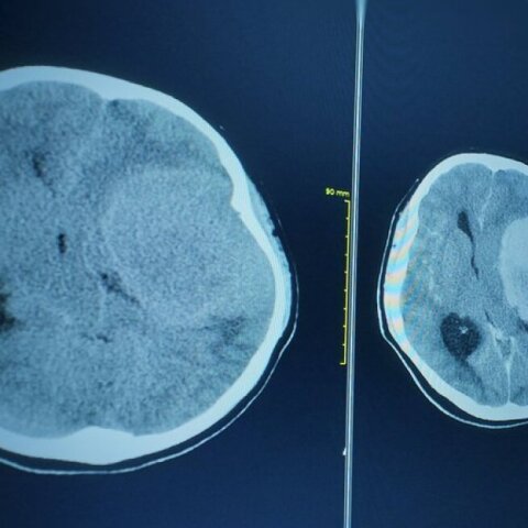  πέθανε από ναιγλερίαση που προκλήθηκε από μια σπάνια αμοιβάδα