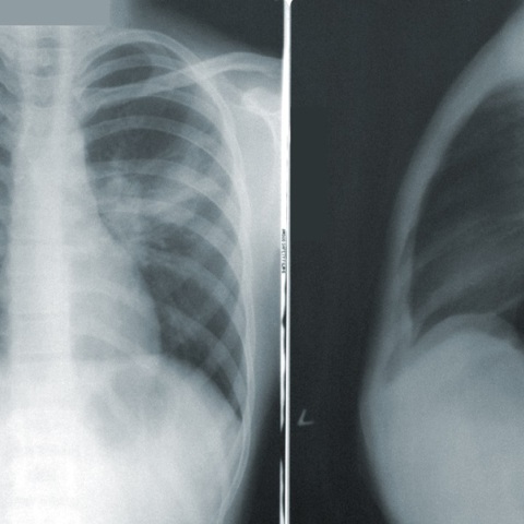 Μαγιορκίνης: Ραγδαία αύξηση της «Λευκής Πνευμονίας» - Πιθανότατα να έχει περιστατικά και στην Ελλάδα 