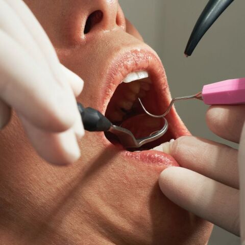 ΗΠΑ: Γυναίκα μηνύει οδοντίατρο για 4 απονευρώσεις, 8 θήκες και 20 σφραγίσματα σε ένα ραντεβού