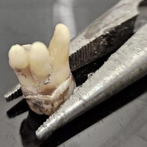 Βρετανία: Πολίτες αναγκάζονται να βγάζουν μόνοι τους τα δόντια τους