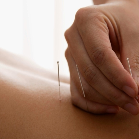 Ο βελονισμός μπορεί να περιορίσει τον κίνδυνο εγκεφαλικού που σχετίζεται με ρευματοειδή αρθρίτιδα	