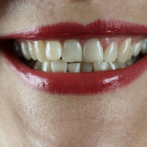 Κίτρινα δόντια: τα δύο λάθη που καταστρέφουν το χαμόγελό σας