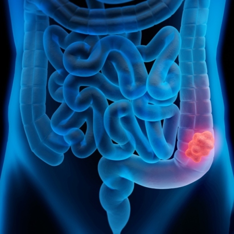 ακτινογραφια παχεος εντερου