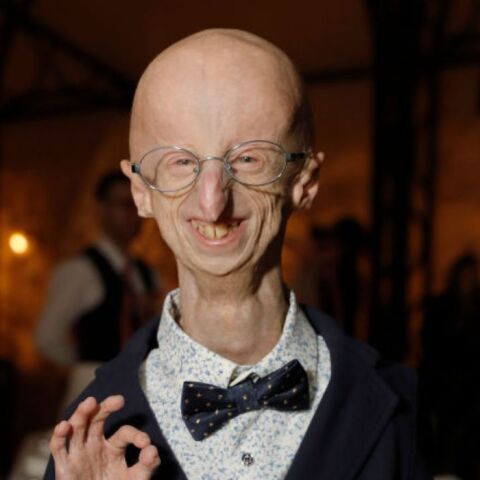 Ιταλία: Πέθανε ο Σάμι Μπάσο που έπασχε από σύνδρομο πρόωρης γήρανσης