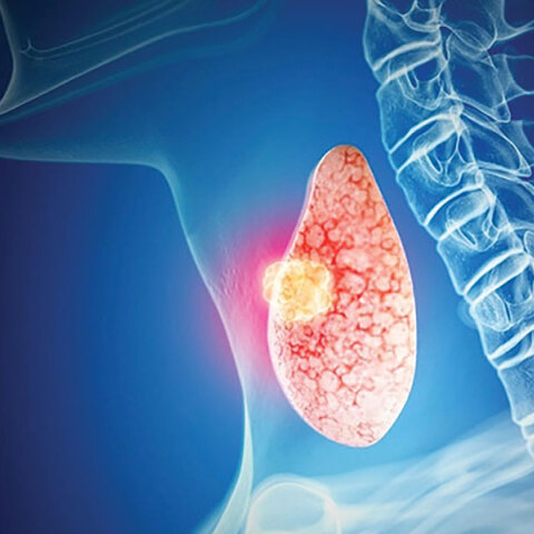 Καρκίνος θυρεοειδούς: Πώς αντιμετωπίζεται και πώς εξελίσσεται;
