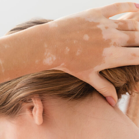 Λεύκη: Τι την προκαλεί και πώς μπορεί να βοηθήσει ο δερματολόγος