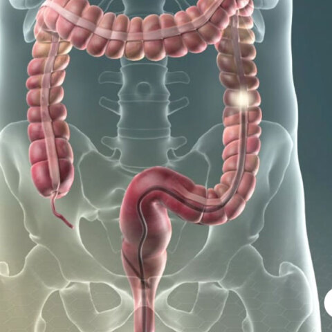 Καρκίνος Παχέος Εντέρου: Γιατί η κολονοσκόπηση είναι το κλειδί της πρόληψης