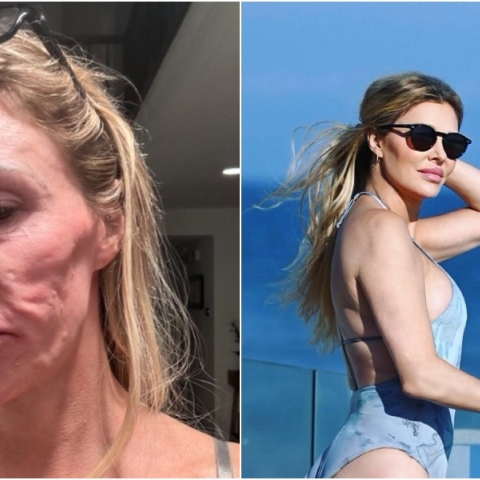 Έχασε τα δόντια της, παραμορφώθηκε το πρόσωπό της: το παράσιτο που μόλυνε τηλεπερσόνα