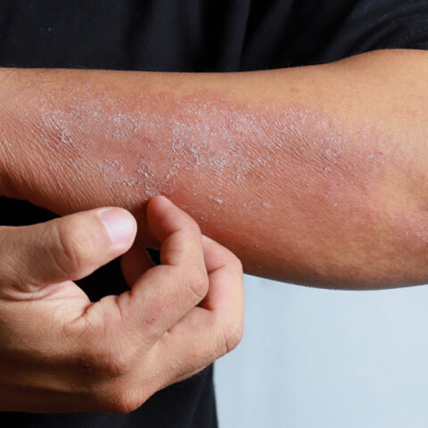 Σε έξαρση η ψωρίαση μετά τις γιορτές