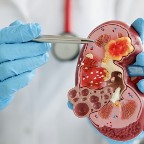 νεφρα, γιατρος