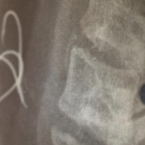 Αγρίνιο: 38χρονος έφαγε χταπόδι με αγκίστρι - Διακομίστηκε στην Αθήνα