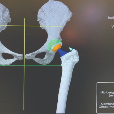 Νεότερες εξελίξεις στην αρθροπλαστική ισχίου