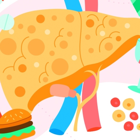 Λιπώδης διήθηση ήπατος | Μέθοδοι πρόληψης και θεραπεία