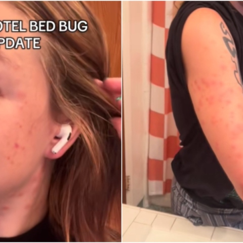 Κοριοί στο Παρίσι: Η σοκαριστική εμπειρία τουρίστριας - Τσιμπήματα σε όλο της το σώμα 