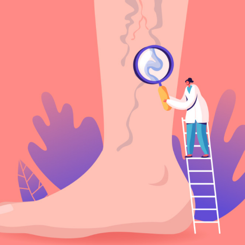 Kιρσοί των κάτω άκρων: 18 ερωτήσεις και απαντήσεις 