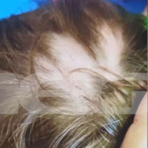 Αυλώνας: Συγκρούονται οι εκδοχές για το 2χρονο παιδί που έλειπαν τούφες από τα μαλλιά του