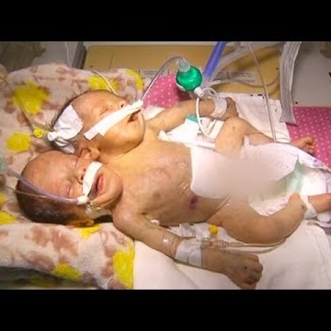 Conjoined twins in Yemen need international support to survive