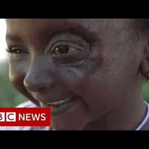 Yemen conflict: Six-year-old Yusra’s new eye - BBC News