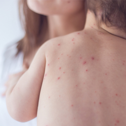 measles-preview.jpg