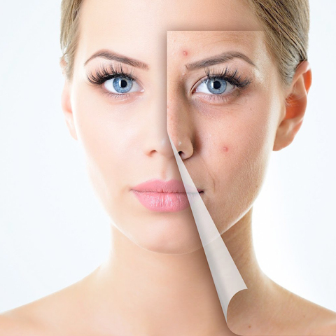 women-acne.jpg